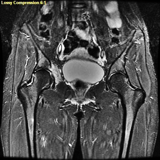 MRI aggressive osteoblastoma of the acetabulum