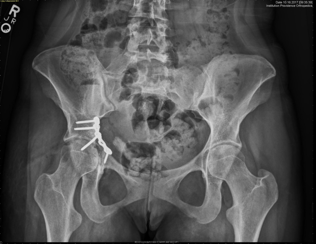 Post-operative X-ray ORIF acetabulum